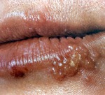 Лечение герпеса народными средствами