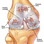 Компресс на коленный сустав при артрозе форум thumbnail