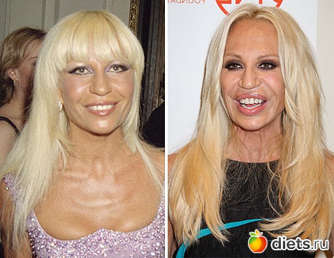 Жертвы пластической хирургии