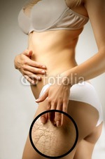 Кто-нибудь избавился хоть на чуть-чуть от растяжек?