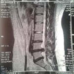 Операционное удаление грыжи, кто сталкивался?