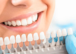 Отбеливание зубов: важные нюансы